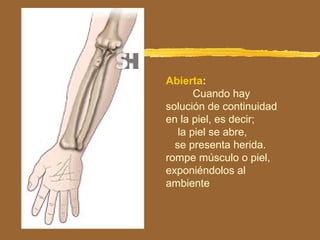 Abierta:
Cuando hay
solución de continuidad
en la piel, es decir;
la piel se abre,
se presenta herida.
rompe músculo o piel,
exponiéndolos al
ambiente
 