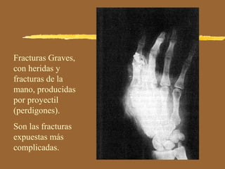 Fracturas Graves,
con heridas y
fracturas de la
mano, producidas
por proyectil
(perdigones).
Son las fracturas
expuestas más
complicadas.
 