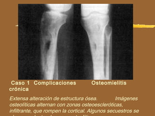 Caso 1 Complicaciones Osteomielitis
crónica
Extensa alteración de estructura ósea. Imágenes
osteolíticas alternan con zonas osteoescleróticas,
infiltrante, que rompen la cortical. Algunos secuestros se
 