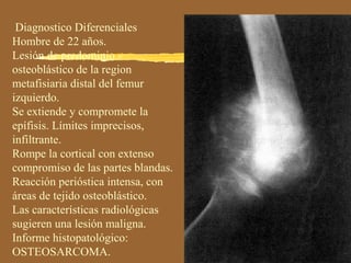 Diagnostico Diferenciales
Hombre de 22 años.
Lesión de predominio
osteoblástico de la region
metafisiaria distal del femur
izquierdo.
Se extiende y compromete la
epífisis. Límites imprecisos,
infiltrante.
Rompe la cortical con extenso
compromiso de las partes blandas.
Reacción perióstica intensa, con
áreas de tejido osteoblástico.
Las características radiológicas
sugieren una lesión maligna.
Informe histopatológico:
OSTEOSARCOMA.
 