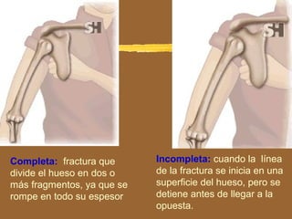 Completa: fractura que
divide el hueso en dos o
más fragmentos, ya que se
rompe en todo su espesor
Incompleta: cuando la línea
de la fractura se inicia en una
superficie del hueso, pero se
detiene antes de llegar a la
opuesta.
 