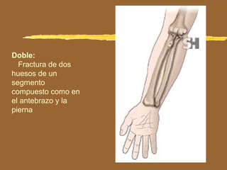 Doble:
Fractura de dos
huesos de un
segmento
compuesto como en
el antebrazo y la
pierna
 