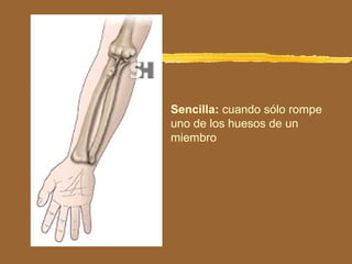 Sencilla: cuando sólo rompe
uno de los huesos de un
miembro
 