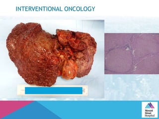 INTERVENTIONAL ONCOLOGY
 
