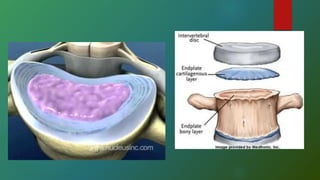 Comprehensive Overview of Hernia de Disco: Anatomy, Biomechanics, and ...