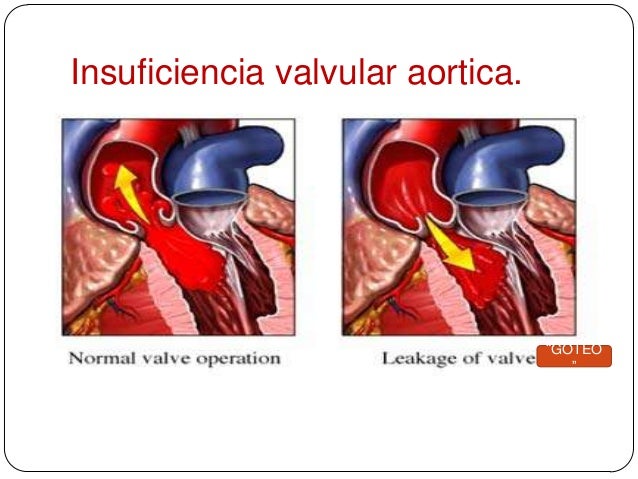 10 insuficiencia aortica.