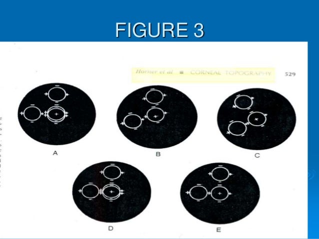 keratometry keratometry