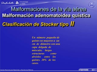Malformaciones de la vía aérea
Malformación adenomatoidea quística
Clasificación de Stocker tipo          II
             ...