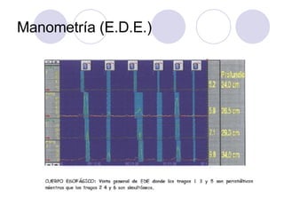 Manometría (E.D.E.) 