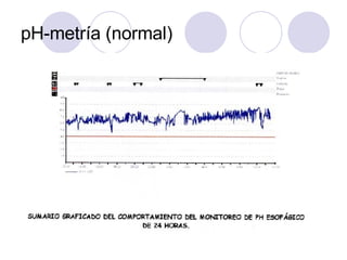 pH-metría (normal) 