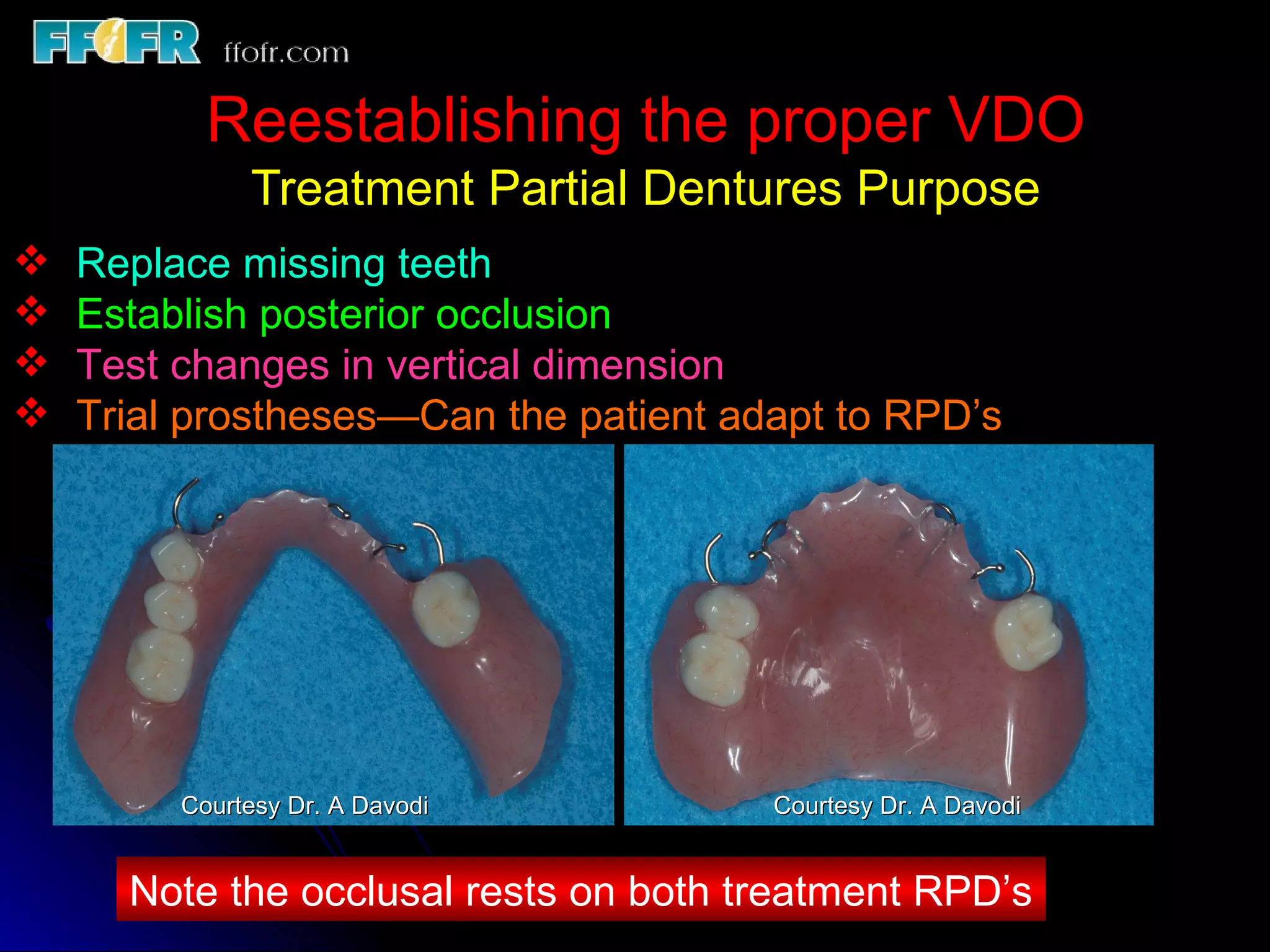 Occlusal Record Rpd 10.maxillo mandibular records | PPT