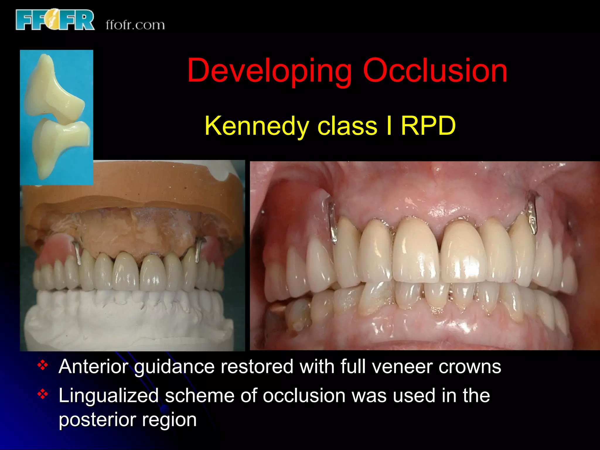 Occlusal Record Rpd 10.maxillo mandibular records | PPT