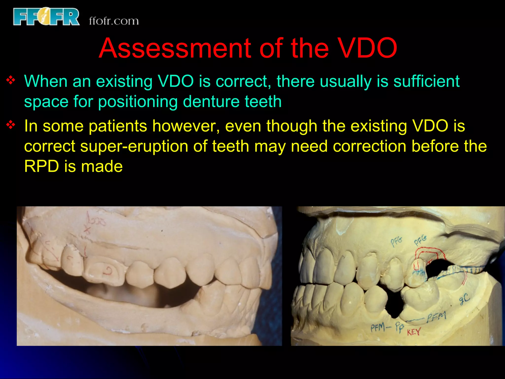 10.maxillo mandibular records | PPT