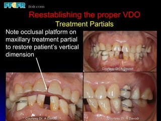 10.maxillo mandibular records | PPT