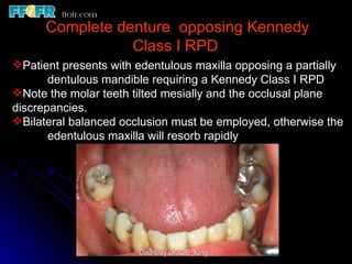 Edentulous Class Rpd 10.maxillo mandibular records | PPT