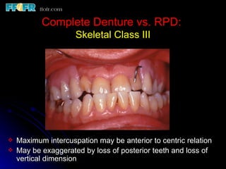 Class 3 Rpd 10.maxillo mandibular records | PPT