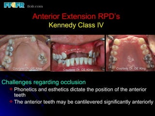 Class Iv Rpd 10.maxillo mandibular records | PPT