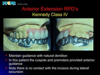 Class Iv Rpd 10.maxillo mandibular records | PPT