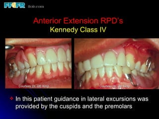 Class Iv Rpd 10.maxillo mandibular records | PPT
