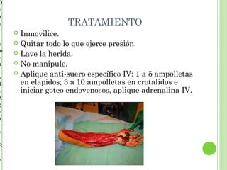 D
e
p
a                  TRATAMIENTO
r
     Inmovilice.
a    Quitar todo lo que ejerce presión.
m    Lave la herida.
e
n    No manipule.
     Aplique anti-suero específico IV: 1 a 5 ampolletas
o
d     en elapidos; 3 a 10 ampolletas en crotalidos e
e     iniciar goteo endovenosos, aplique adrenalina IV.
A
g
e
n

e
s
B

o
 