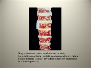 Bony metastases - adenocarcinoma of prostate:
Metastatic osteoblastic prostatic carcinoma within vertebral
bodies. Primary lesion of any osteoblastic bony metastases
in a male is prostatic
25
 