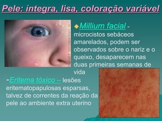 -Eritema tóxico – lesões
eritematopapulosas esparsas,
talvez de correntes da reação da
pele ao ambiente extra uterino
Millium facial -
microcistos sebáceos
amarelados, podem ser
observados sobre o nariz e o
queixo, desaparecem nas
duas primeiras semanas de
vida
Pele: íntegra, lisa, coloração variável
 