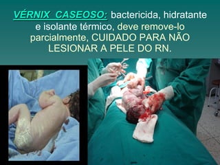 VÉRNIX CASEOSO: bactericida, hidratante
e isolante térmico, deve remove-lo
parcialmente, CUIDADO PARA NÃO
LESIONAR A PELE DO RN.
 