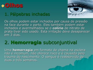 Olhos
1. Pálpebras inchadas
Os olhos podem estar inchados por causa de pressão
na face durante o parto. Eles também podem estar
inchados e avermelhados se o colírio de nitrato de
prata tiver sido usado. Esta irritação deve desaparecer
em 3 dias.
2. Hemorragia subconjuntival
Uma hemorragia em formato de chama na esclera
não é incomum, não oferece risco e é causada pelo
trauma do nascimento. O sangue é reabsorvido de
duas a três semanas.
 