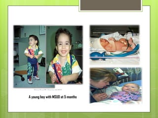 A young boy with MSUD at 5 months
 
