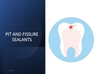 PIT AND FISSURE
SEALANTS
17-08-2022
 