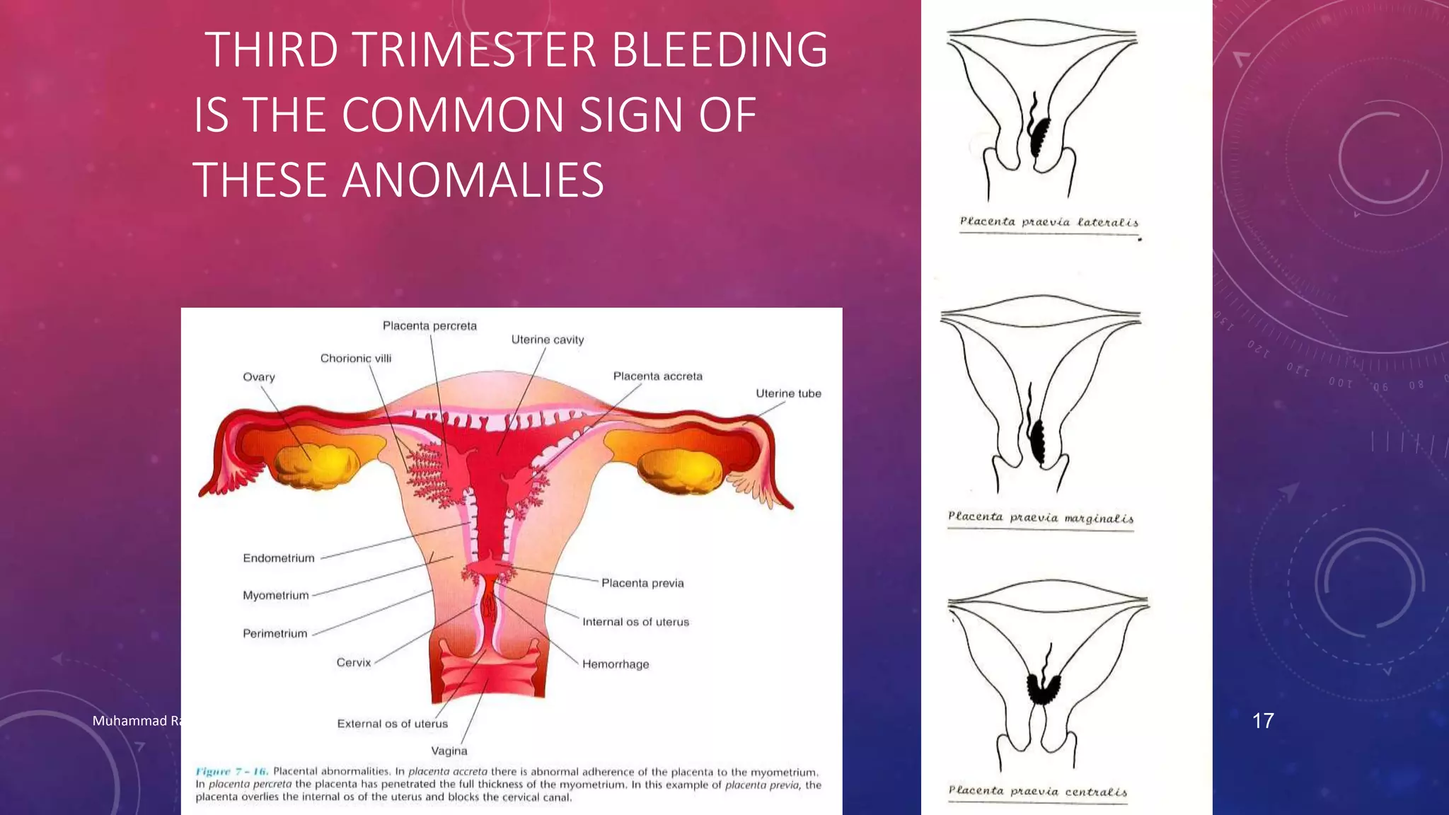 THIRD TRIMESTER BLEEDING 
IS THE COMMON SIGN OF 
THESE ANOMALIES 
Muhammad Ramzan Ul Rehman 17 
 