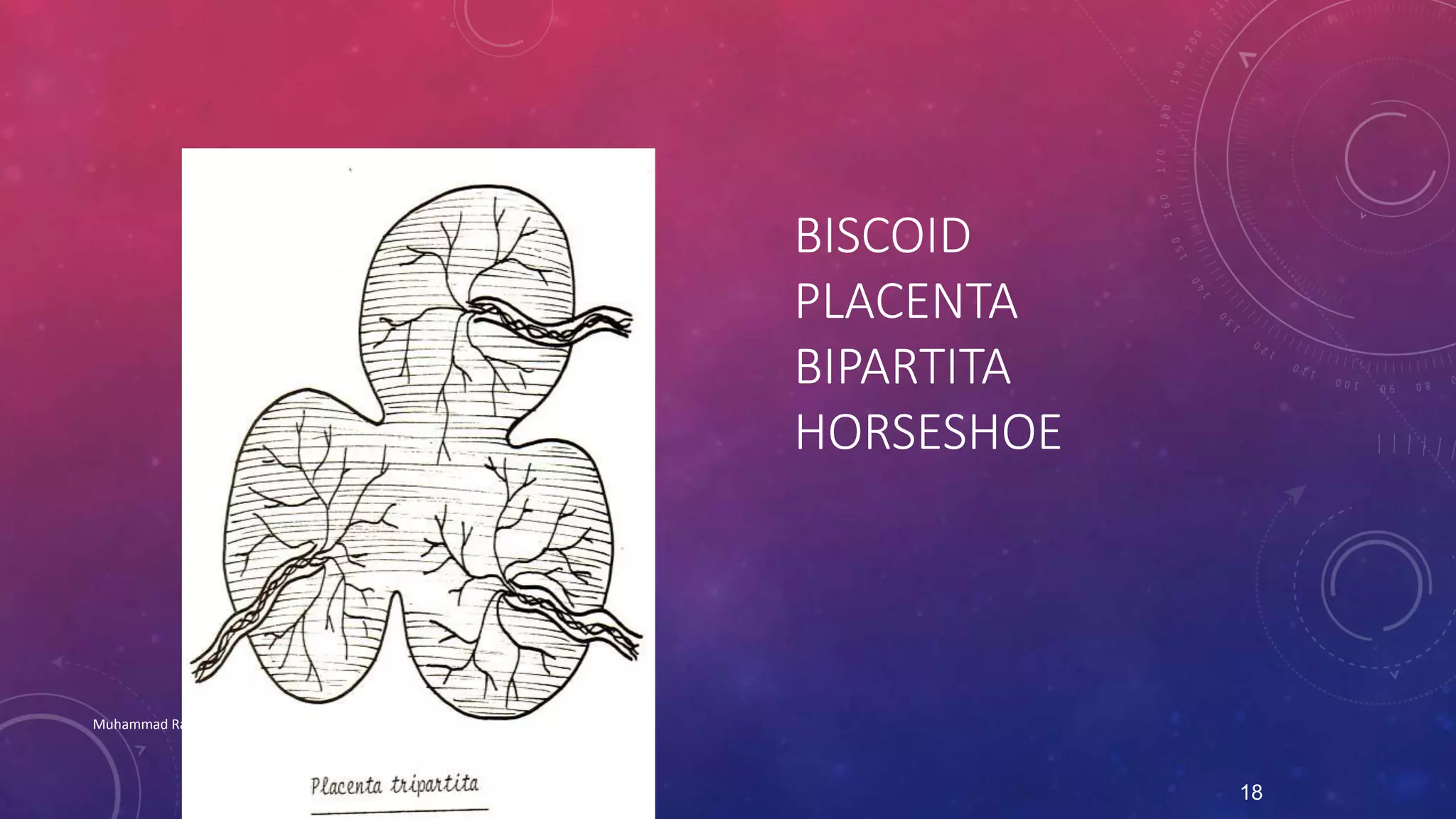BISCOID 
PLACENTA 
BIPARTITA 
HORSESHOE 
Muhammad Ramzan Ul Rehman 
18 
 