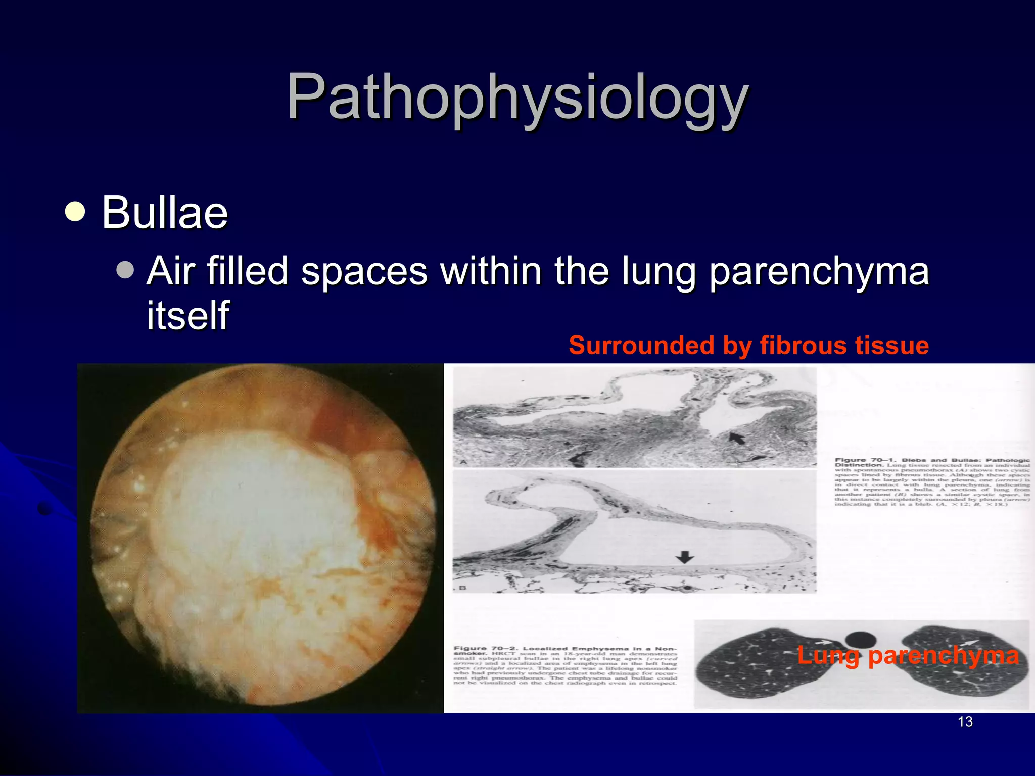 Bullae Air filled spaces within the lung parenchyma itself Pathophysiology Lung parenchyma Surrounded by fibrous tissue 