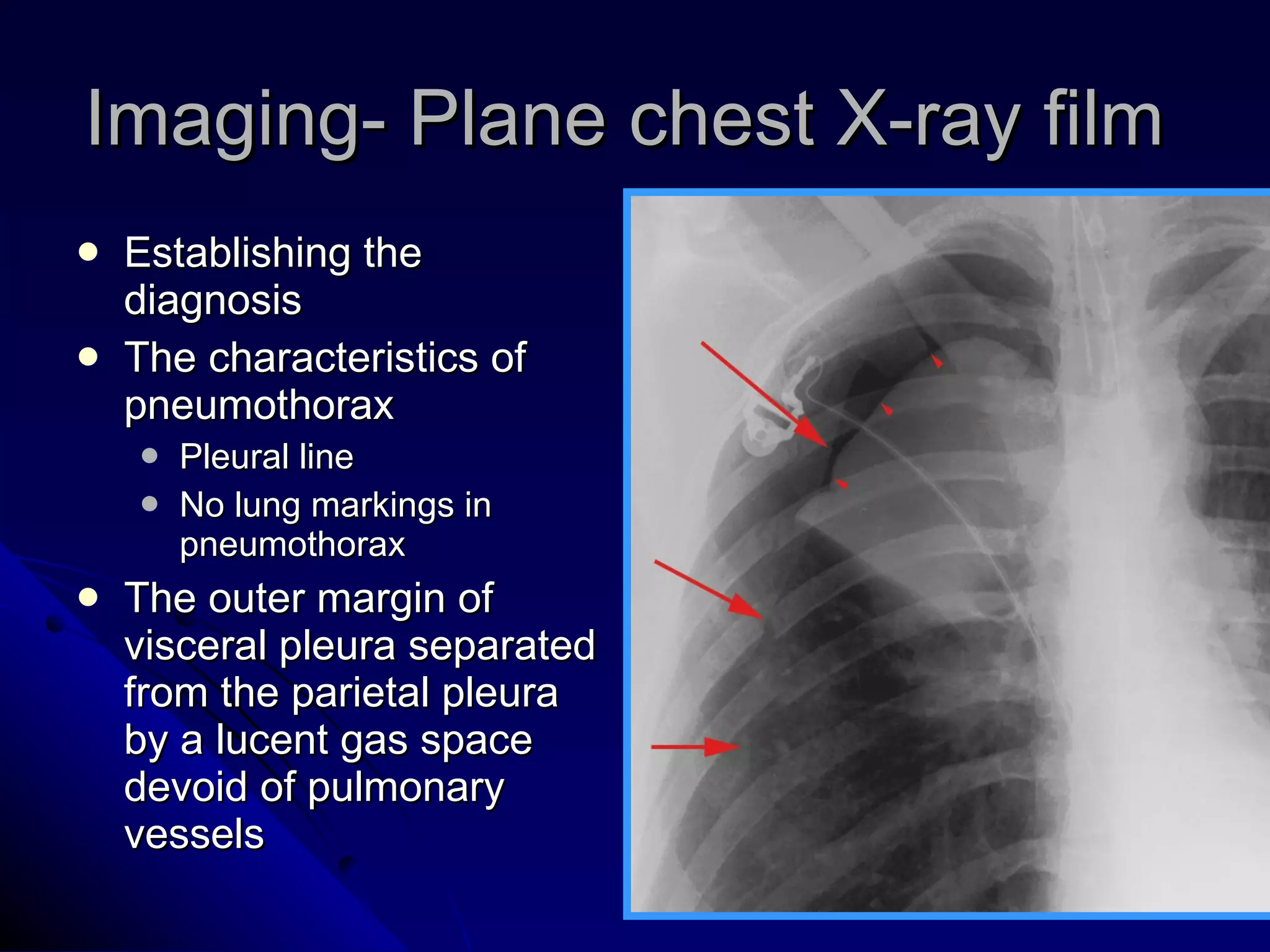 Imaging- Plane chest X-ray film  Establishing the diagnosis The characteristics of pneumothorax Pleural line No lung markings in pneumothorax The outer margin of visceral pleura separated from the parietal pleura by a lucent gas space devoid of pulmonary vessels  