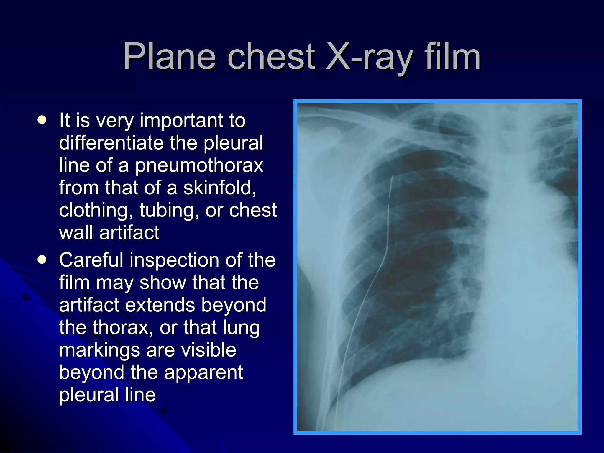 Plane chest X-ray film It is very important to differentiate the pleural line of a pneumothorax from that of a skinfold, clothing, tubing, or chest wall artifact Careful inspection of the film may show that the artifact extends beyond the thorax, or that lung markings are visible beyond the apparent pleural line 