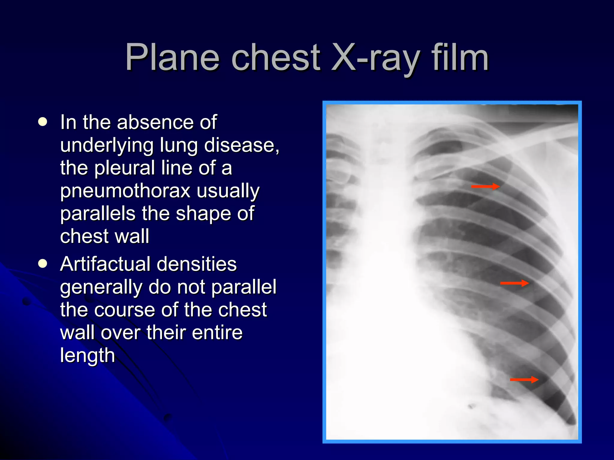 Plane chest X-ray film In the absence of underlying lung disease, the pleural line of a pneumothorax usually parallels the shape of chest wall Artifactual densities generally do not parallel the course of the chest wall over their entire length 