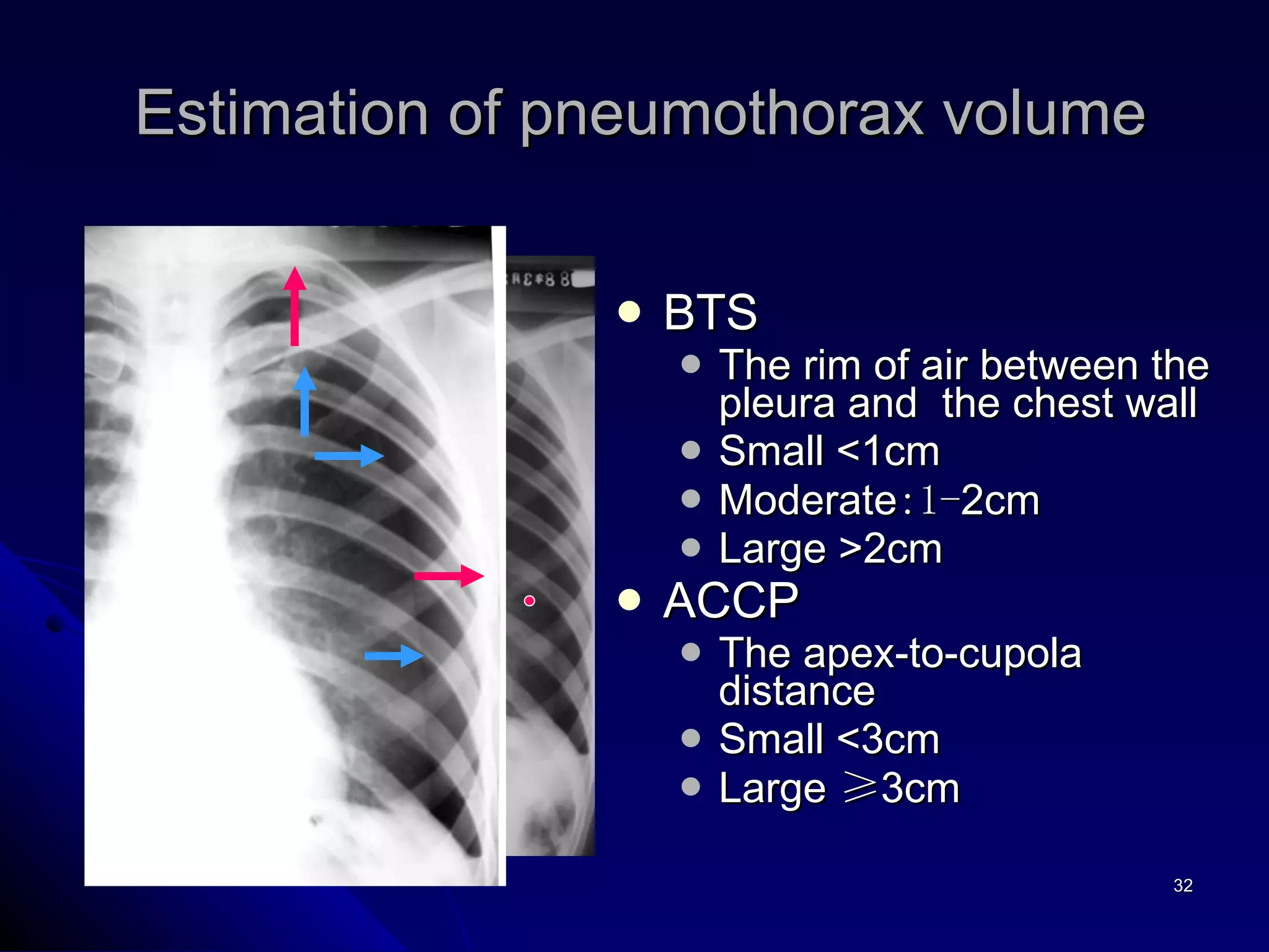 BTS  The rim of air between the pleura and  the chest wall Small <1cm Moderate :1- 2cm Large >2cm ACCP The apex-to-cupola distance Small <3cm Large  ≥ 3cm Estimation of pneumothorax volume 