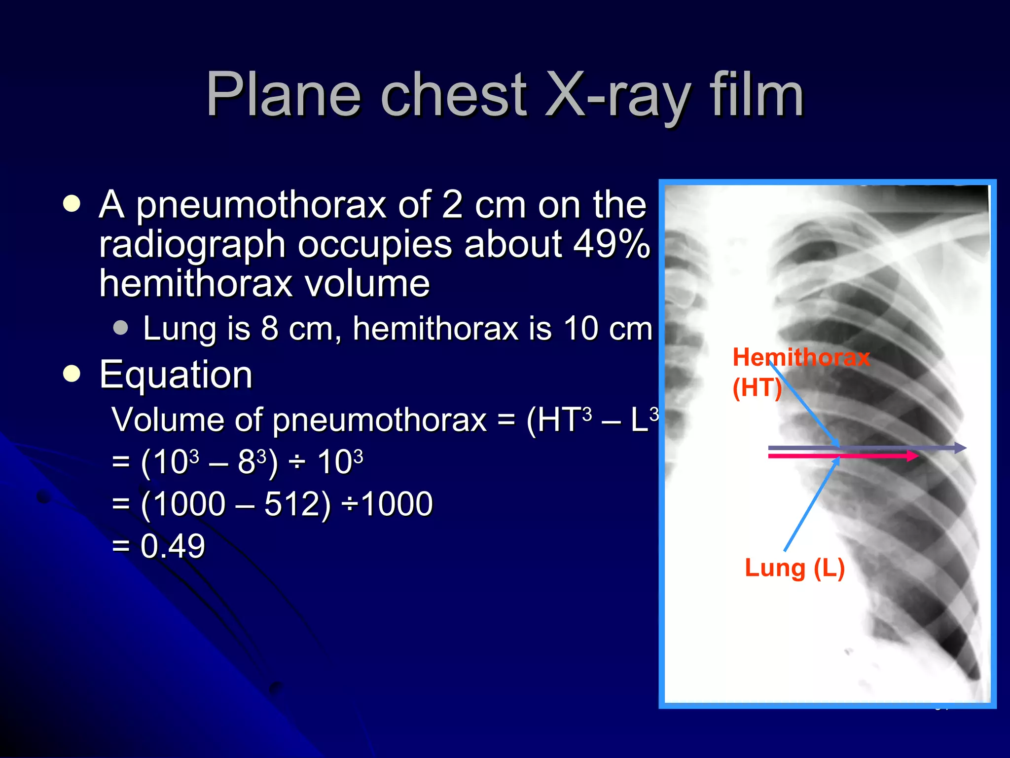 A pneumothorax of 2 cm on the PA chest radiograph occupies about 49% of the hemithorax volume Lung is 8 cm, hemithorax is 10 cm in diameter Equation  Volume of pneumothorax = (HT 3  – L 3 ) ÷ HT 3 = (10 3  – 8 3 ) ÷ 10 3   = (1000 – 512) ÷1000 = 0.49 Plane chest X-ray film Hemithorax (HT) Lung (L) 