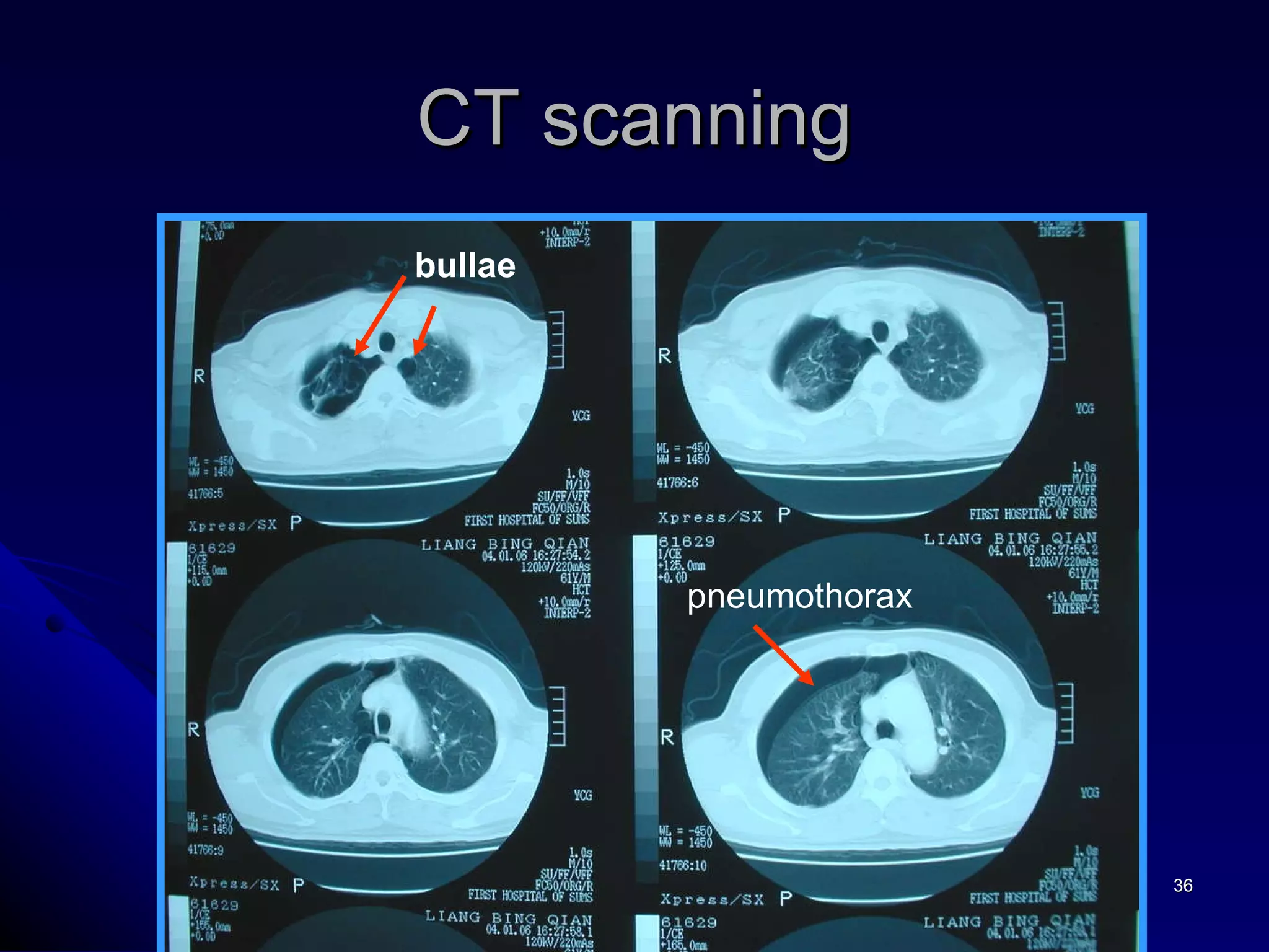 CT scanning bullae pneumothorax 