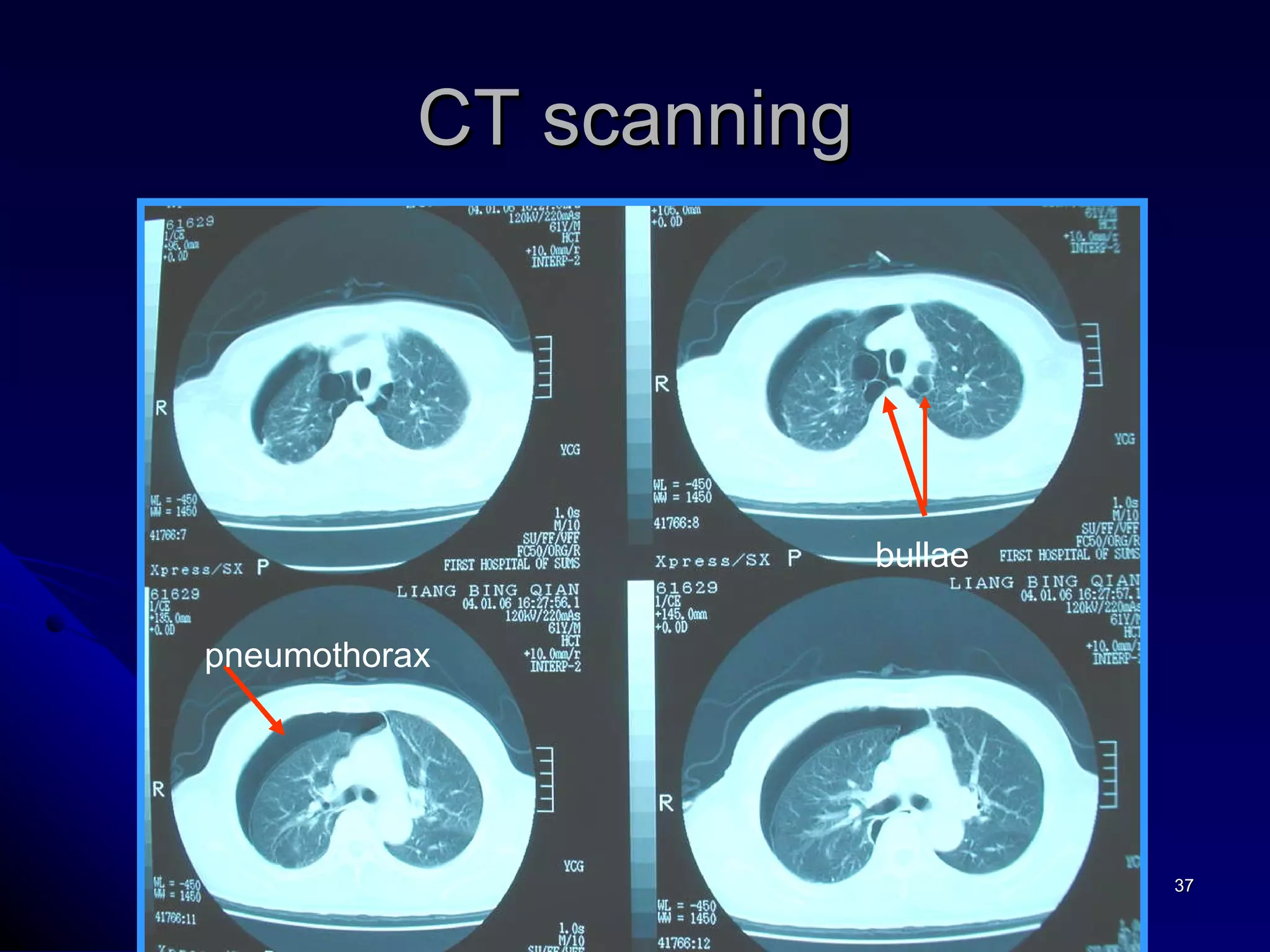 CT scanning bullae pneumothorax pneumothorax 