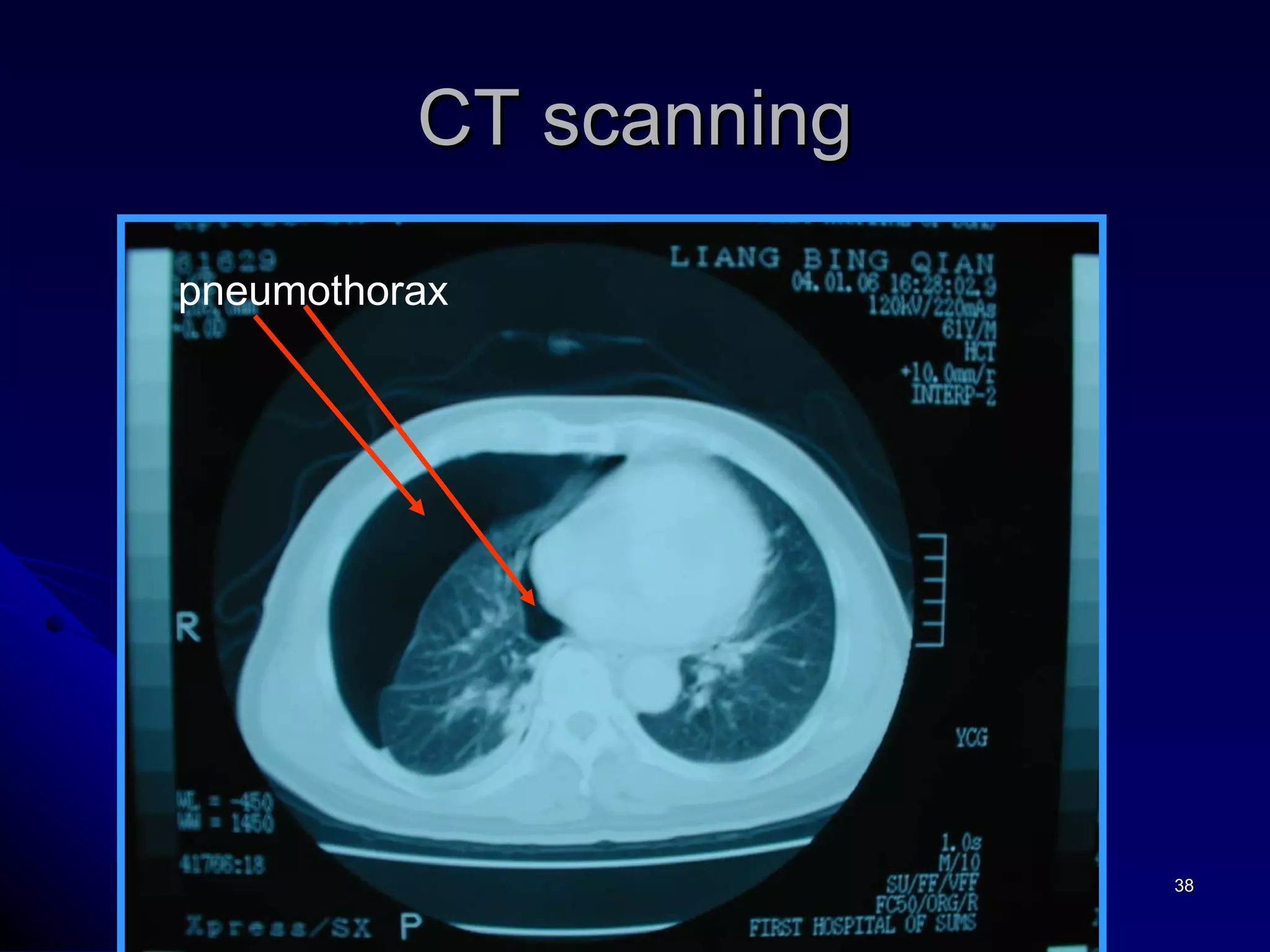CT scanning pneumothorax 