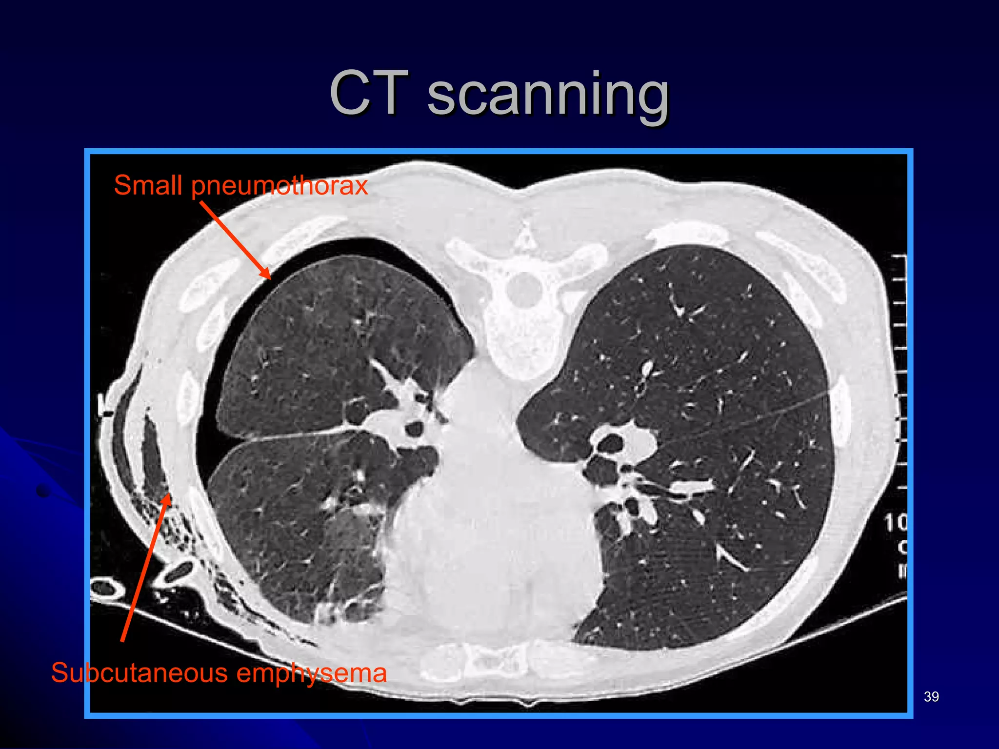 CT scanning Small pneumothorax Subcutaneous emphysema 