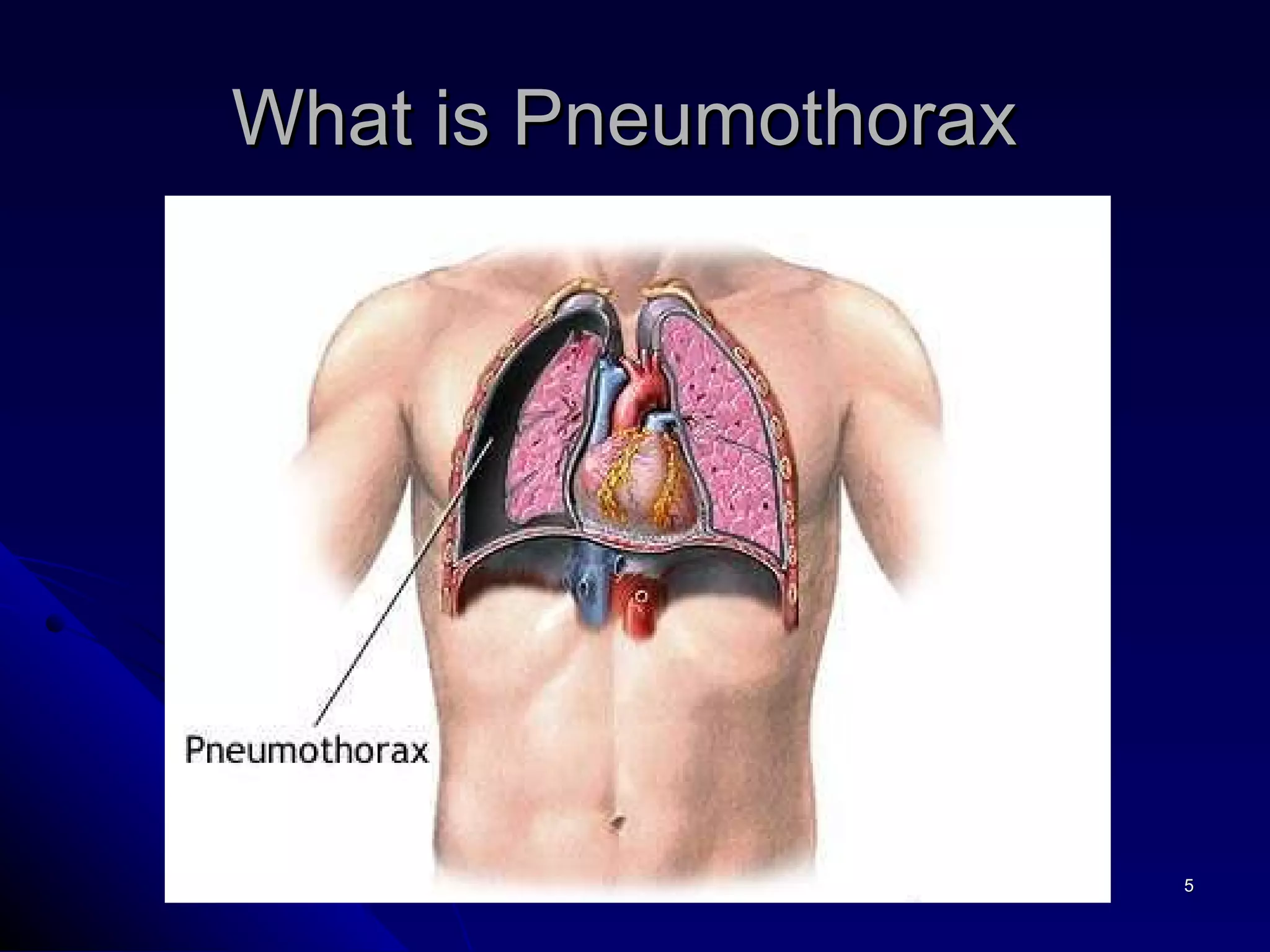 What is Pneumothorax  