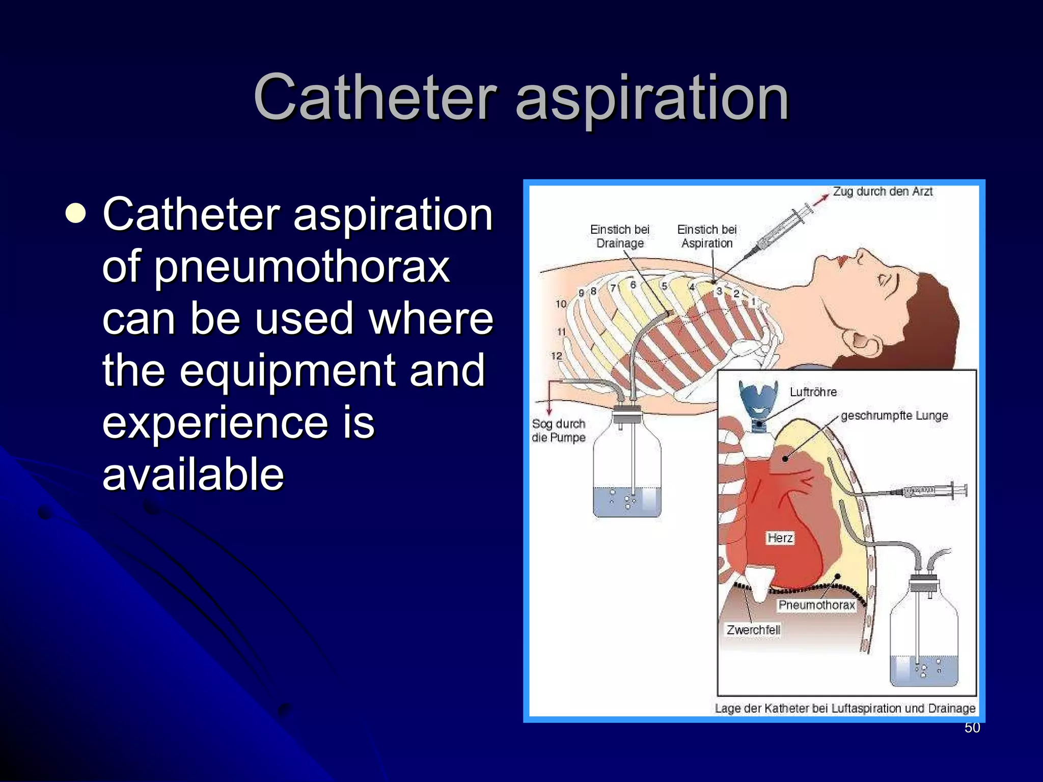 Catheter aspiration Catheter aspiration of pneumothorax can be used where the equipment and experience is available 