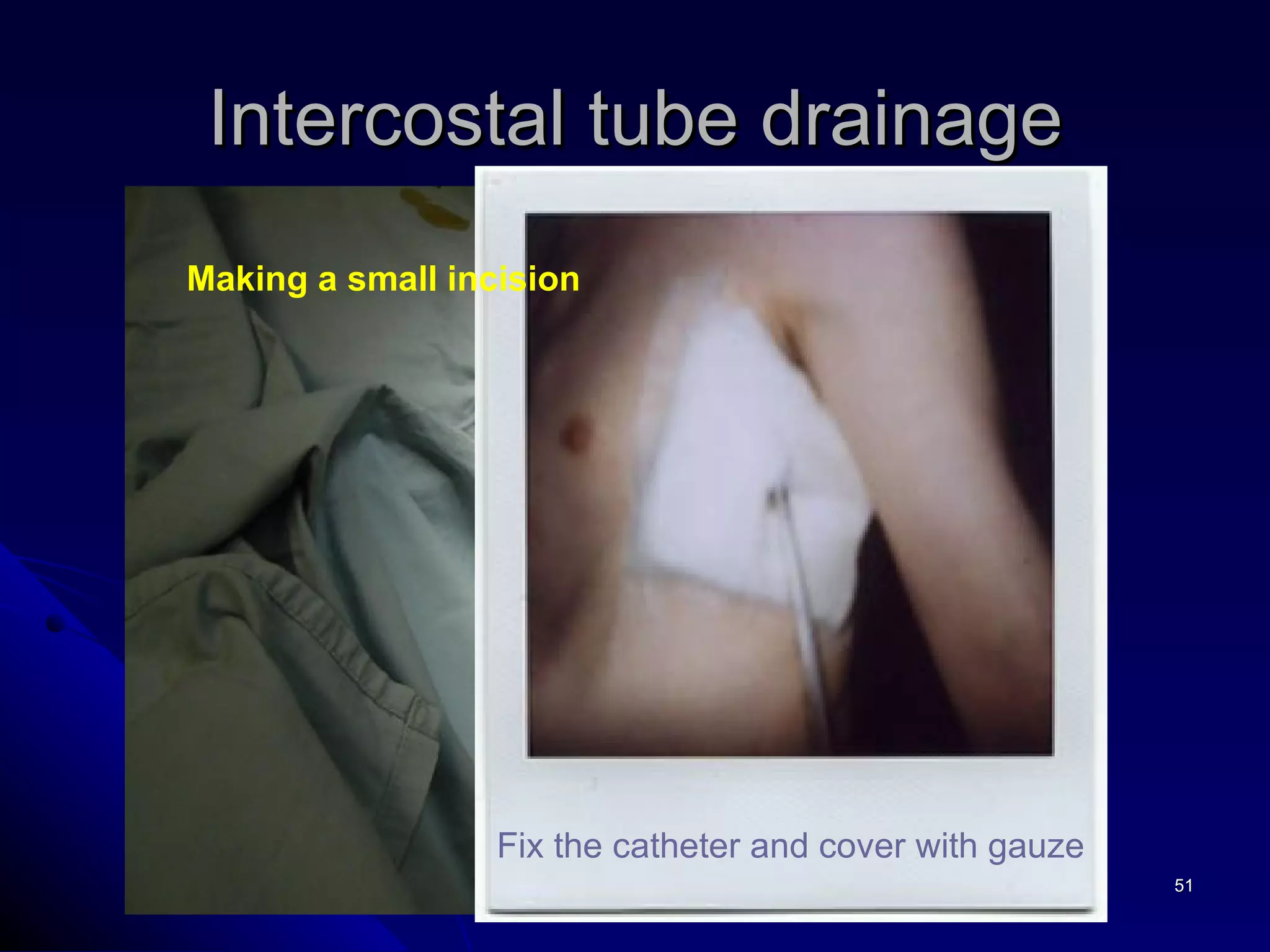 Intercostal tube drainage Fix the catheter and cover with gauze Making a small incision  