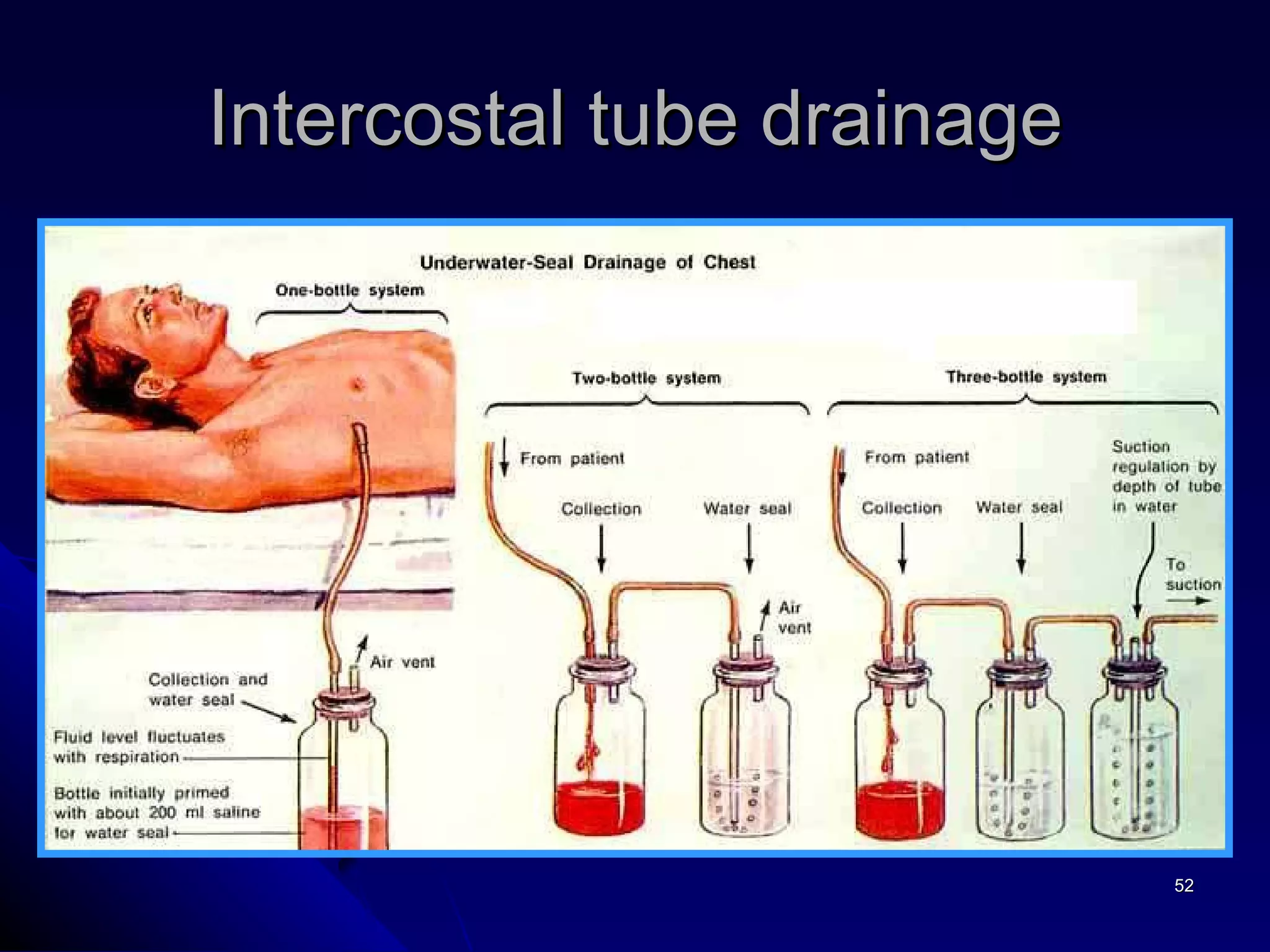 Intercostal tube drainage 