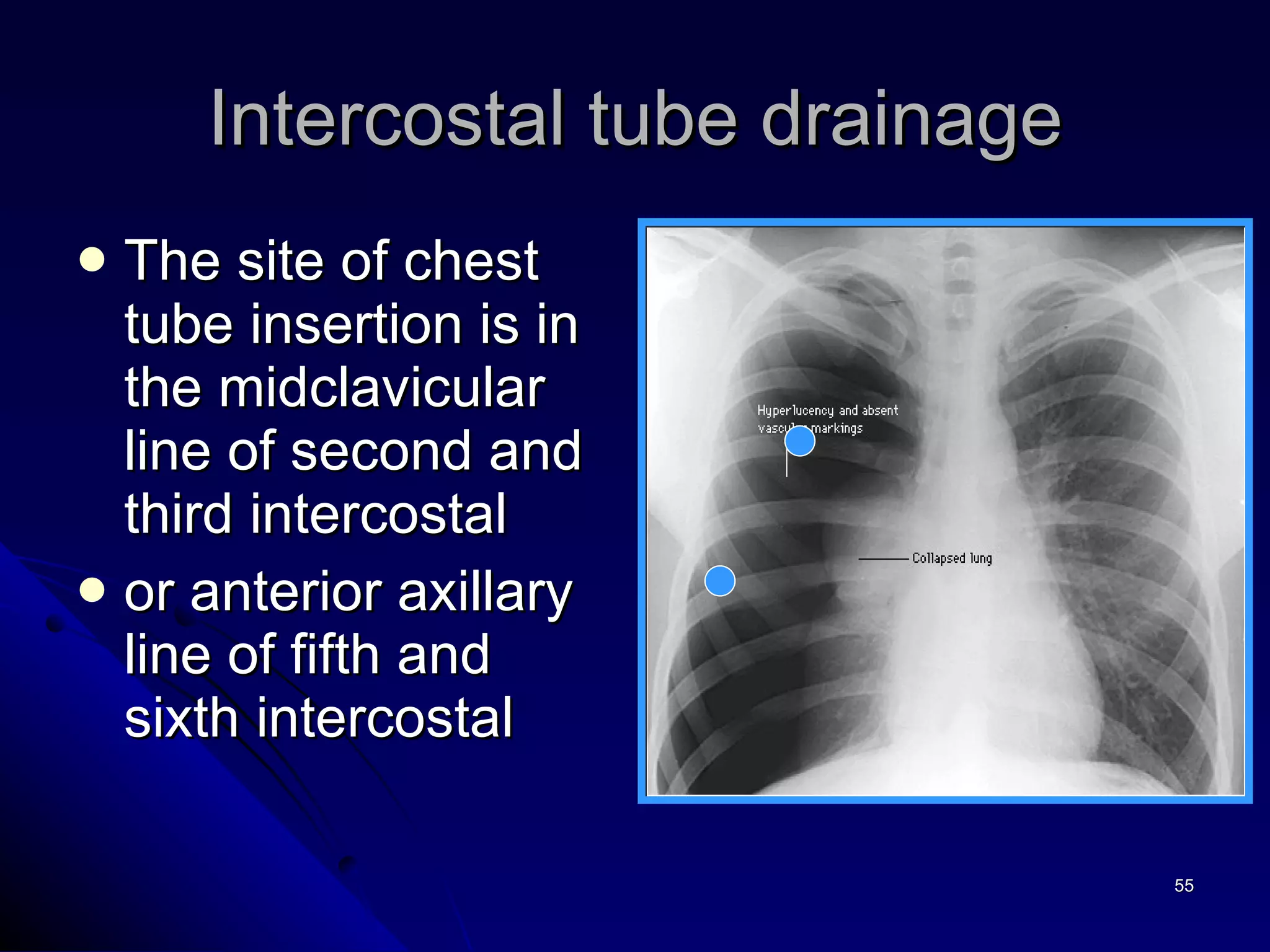 The site of chest tube insertion is in the midclavicular line of second and third intercostal or anterior axillary line of fifth and sixth intercostal Intercostal tube drainage 