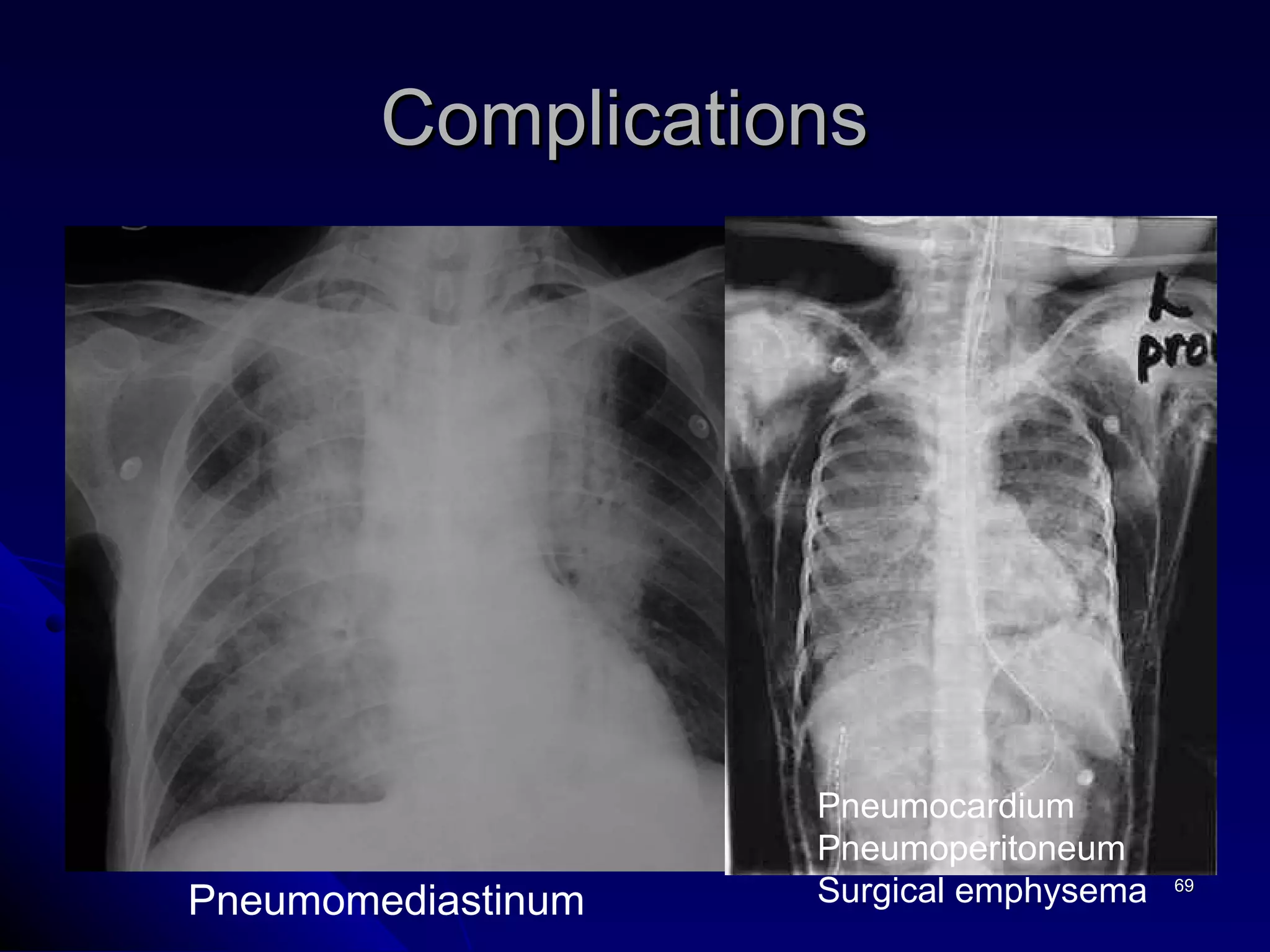 Complications  Pneumomediastinum  Pneumocardium Pneumoperitoneum Surgical emphysema 