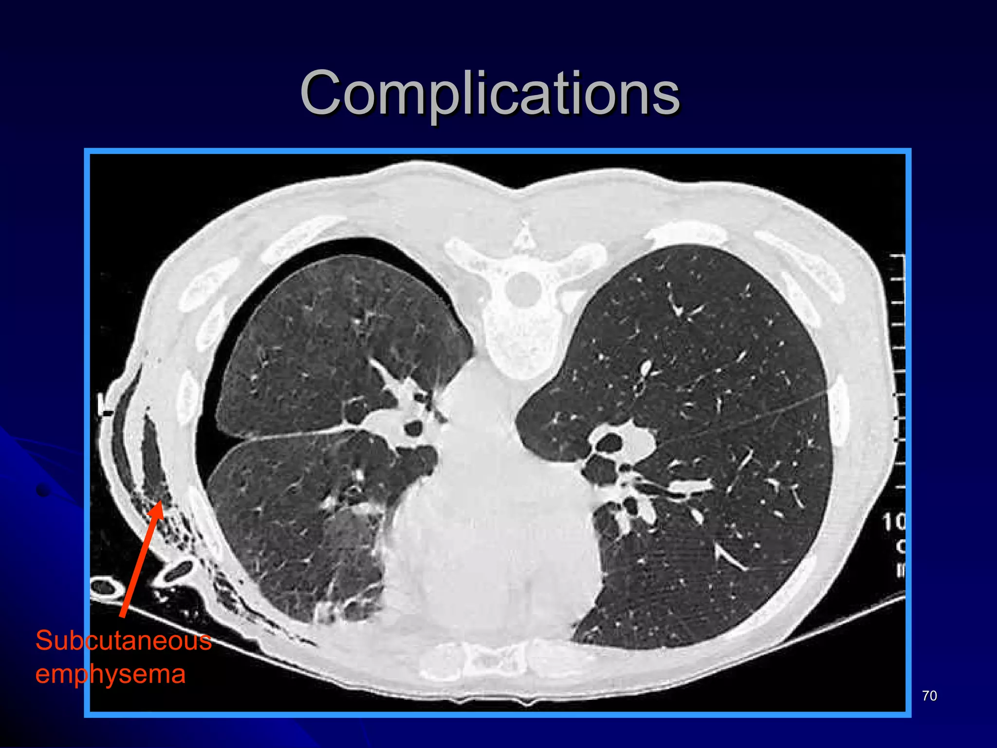 Complications  Subcutaneous  emphysema 