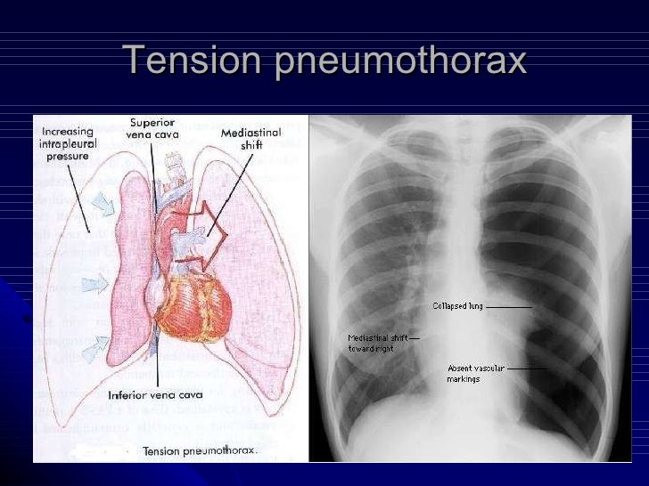 10pneumothorax